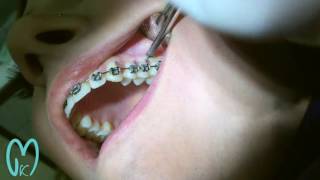 Orthodontic MiniImplants Placement  الزراعات المصغرة المساعدة لتقويم الأسنان [upl. by Alanna]