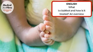 What is clubfoot and how is it treated An overview [upl. by Alyehc]