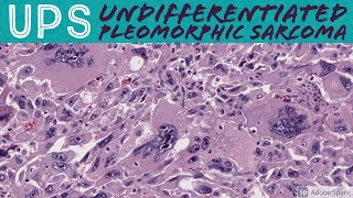 Undifferentiated Pleomorphic Sarcoma 101 UPS formerly malignant fibrous histiocytomaMFH [upl. by Langelo]