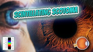 Scintillating scotoma Your EYEBALLS 👁️👁️💉😳💊🔊💯✅ [upl. by Haden]