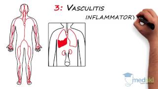 Rheumatology – Polyarticular Pain By Lori Albert MD [upl. by Sik]