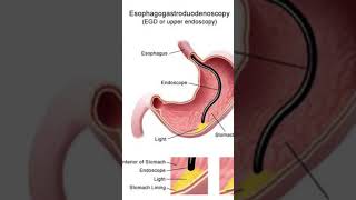 Esophagogastroduodenoscopy is a diagnostic endoscopic procedure gastroesophageal esophageal yt [upl. by Eirased768]