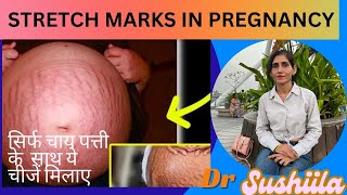 Remove Stretch Marks at Home  Pregnancy Ke Stretch Marks Hataye Naturally  stretchmarks [upl. by Cadal]