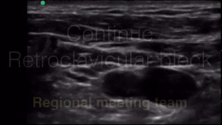 Continue Retroclavicular Brachial Plexus block [upl. by Assirt657]