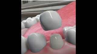 Dental Crowns What They Are amp Why We Need Them [upl. by Nosnej]