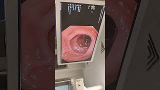 Endoscopy procedure [upl. by Bajaj987]