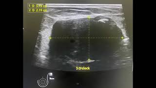 Fibroadenoma Breast [upl. by Bachman]