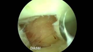 L5s1 large pivd by ubeBiportal endoscopic spine surgery with Flavum fenestration Dr Atmaranjan [upl. by Nonez]