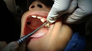 upper left Deciduous teeth extraction  contact number 07979778875  DrTeethSohel Semapur [upl. by Alphard]