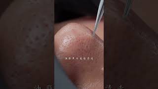 Take good care of your skin during the season change immersiveskincare blackheads asmr facespa [upl. by Sorodoeht]