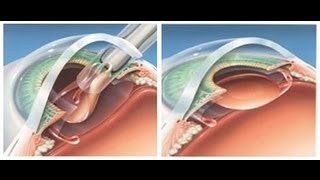 Cataract Surgery Animation [upl. by Eerok]