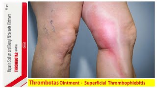 Thrombotas Ointment  Benzyl Nicotinate  Heparin  Treat superficial Thrombophlebitis [upl. by Areem996]