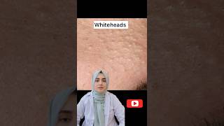 Get Acne free Skin 5 medicines for pimples blackheads and whiteheads trending viralvideo [upl. by Barb]