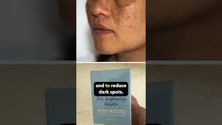 My favourite solutions melasma strawberry skin sunscreen Dr Sarin [upl. by Airan579]