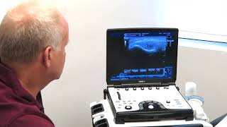 Tennis Elbow Ultrasound Assessment with PRP injection [upl. by Haldane]