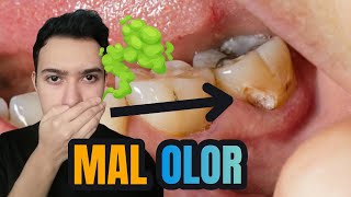 ✔️ Por que mi muela HUELE MAL  mal aliento por MUELA PICADA  MAL ALIENTO en la boca por CARIES👈🤢 [upl. by Euphemie793]