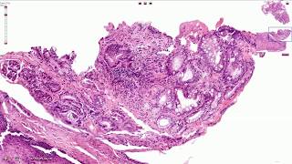 Barrett Esophagus  Histopathology [upl. by Aerehs]