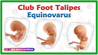 Club foot  Talipes equinovarus  Causes Symptoms Diagnosis and Treatment [upl. by Balfore]