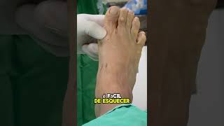 Joanete na Cirurgia Percutânea joanete halluxvalgus bunions bunion [upl. by Ramah789]