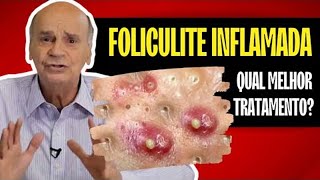 FOLICULITE INFLAMADA QUAL MELHOR TRATAMENTO   DESCUBRA [upl. by Einnol640]