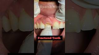 Fractured Tooth Immediate Extraction and Implant Placement dentalimplants doctor dentist shorts [upl. by Tiffanle234]