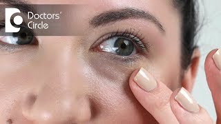 Causes of long lasting red splotcheses under the eyes  Dr Rasya Dixit [upl. by Flieger]