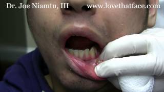 Lip Piercing RemovalPiercings Stuck in Lipwmv [upl. by Petrick]