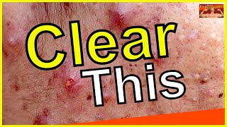 Acne on TRT  EXPERT Dermatologist Advice you NEED to Learn  Back Acne  Steroid Acne [upl. by Apul731]