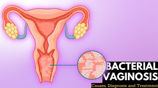 Bacterial vaginosis Causes Signs and Symptoms DIagnosis and Treatment [upl. by Rempe733]