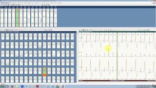 Typcial ECG analysis with ECGpro Holter 743 [upl. by Nickolas]