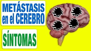 Todos los Síntomas de las Metástasis en el Cerebro [upl. by Yesnil]