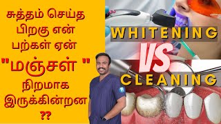 Teeth Cleaning Vs Teeth Whitening  சுத்தம் செய்த பிறகு என் பற்கள் ஏன் quotமஞ்சள் quotநிறமாக இருக்கின்றன [upl. by Asiel]