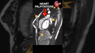 Heart PALPITATIONS under MRI🫀⚡️ anxiety cardiology [upl. by Aisilef]