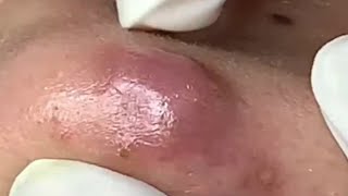 Blackheads Removal  Acne Treatment and Very Satisfying Satisfying Pimple pop blackheads [upl. by Eras]