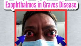 Exophthalmos or Proptosis in Graves Disease Thyroid eye disease Bulged eye [upl. by Alica736]