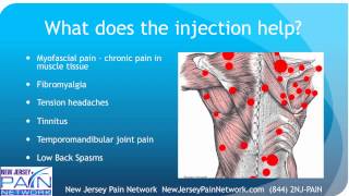 Overview of Trigger Point Injections Explained by a NJ Pain Clinic [upl. by Ame]