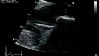 1 PROLAPSE MITRAL VALVE PARASTERNAL LONG AXIS [upl. by Arihas]