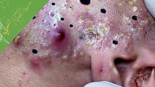 Acne Treatment  Blackhead extraction Every Day With XINH SPA 9 71 [upl. by Billen]