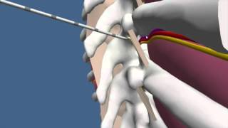 Techniques for Thoracic Paravertebral Block TPVB [upl. by Heywood]