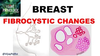 Diseases of Breast Part 1 Normal anatomy Classification amp FIBROCYSTIC CHANGES [upl. by Sparrow757]