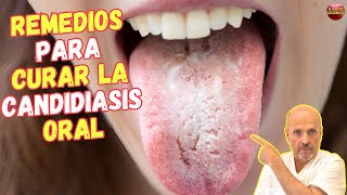 🆘 CANDIDIASIS EN LA BOCA ¿COMO SE CURA CON REMEDIOS CASEROS 🆘 [upl. by Grove886]