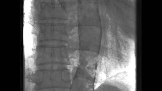 Dense Calcification in the Aorta [upl. by Yate]