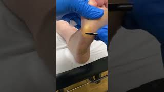 Expert Australian Podiatrist Removes Thick Callus from Forefoot with Precision [upl. by Jonme]