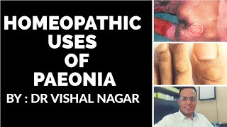 Homeopathic medicine PAEONIA for piles fistula fissure corns bunion and bed sores by Dr Vishal [upl. by Mackey]