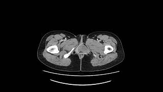 Bartholin gland cyst [upl. by Mur]