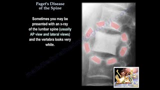 Pagets Disease Of The Spine  Everything You Need To Know  Dr Nabil Ebraheim [upl. by Mazman]