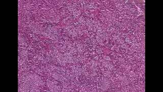 Histopathology PituitaryAcidophilic adenoma [upl. by Nowell]