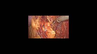 Laparoscopic Nephrectomy by Dr Negi [upl. by Cappella663]