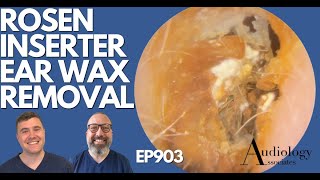 ROSEN INSERTER EAR WAX REMOVAL amp OTHERS  EP903 [upl. by Dixil]