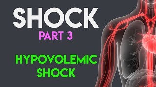 Hypovolemic Shock [upl. by Lellih]